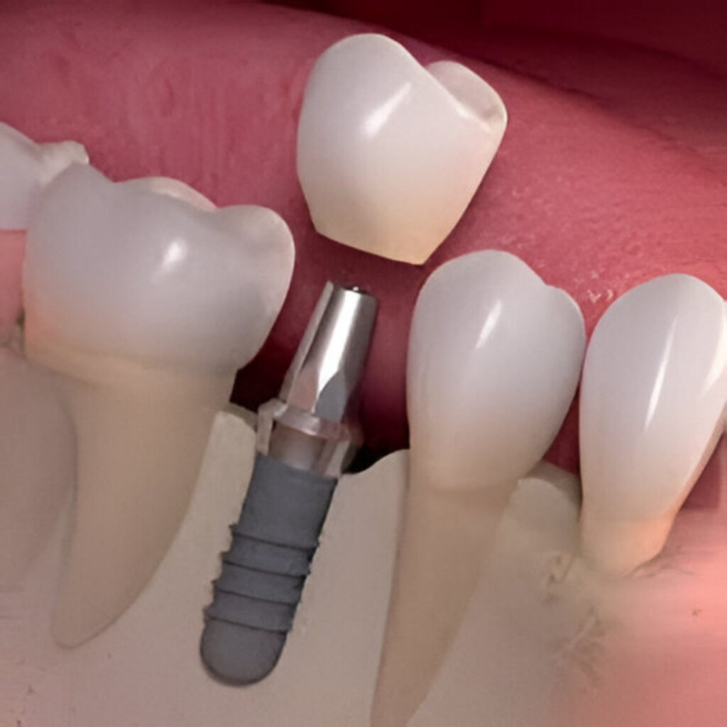 Implant Dentistry